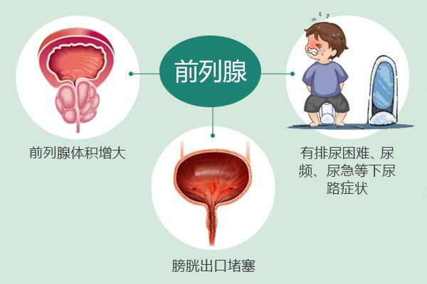 前列腺增生患者如何自我保健(图2)