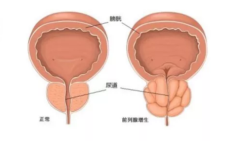 前列腺增生吃啥药能治好(图3)