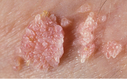 感染人乳头瘤病毒图片