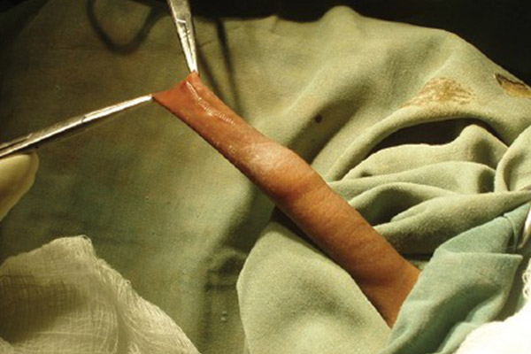 包茎为什么需要进行包皮割除手术